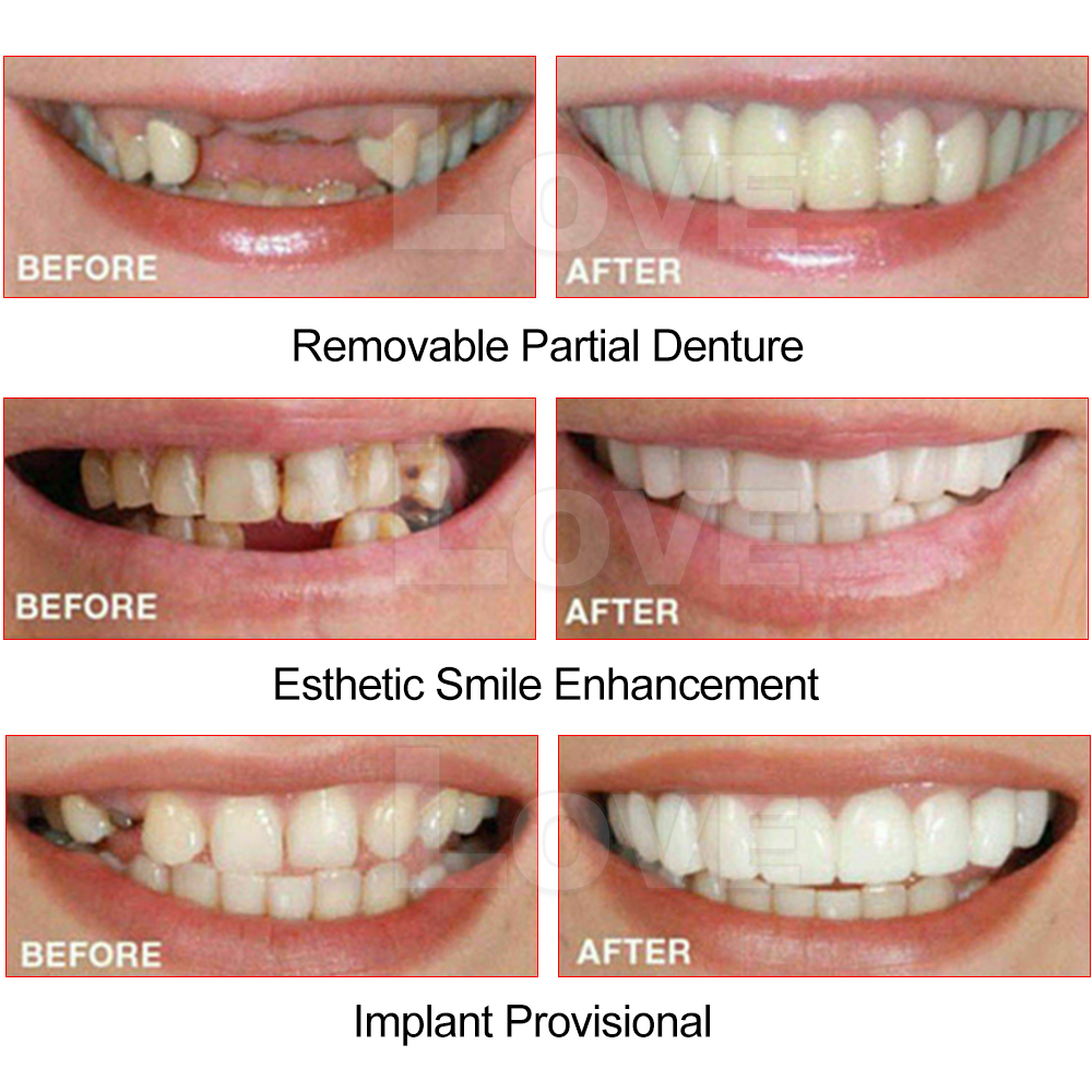 Snap On Bottom /Upper Lower False Teeth Dental Veneers Dentures Fake ...
