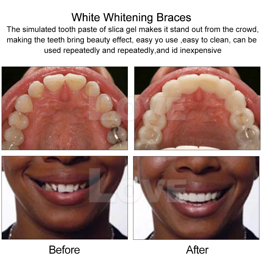 Snap On Bottom /Upper Lower False Teeth Dental Veneers Dentures Fake ...
